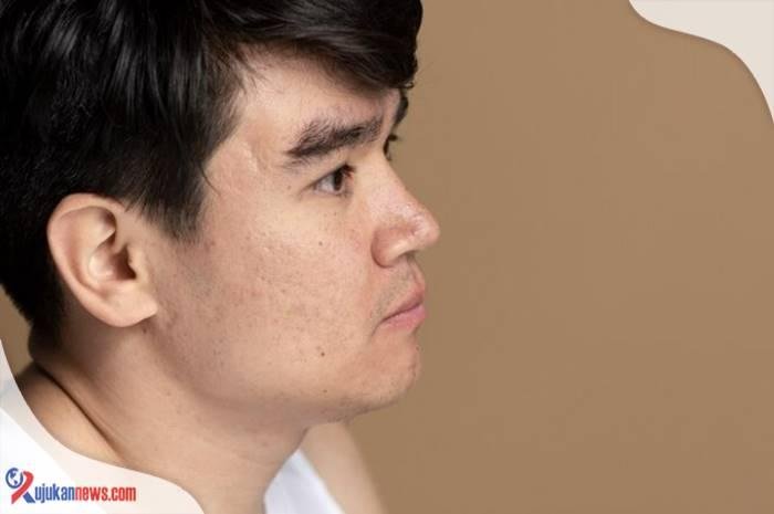 cara menghilangkan bekas jerawat