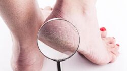 Berjalan Kurang Nyaman? Ini Dia 5 Cara Merawat Kaki Kering dan Kusam, Cukup Pahami Saja!