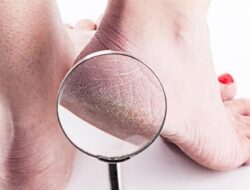 Berjalan Kurang Nyaman? Ini Dia 5 Cara Merawat Kaki Kering dan Kusam, Cukup Pahami Saja!