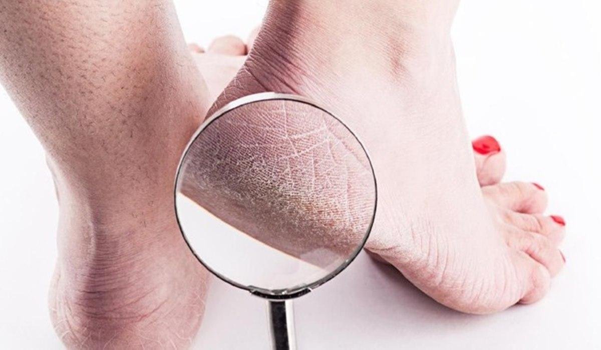 cara merawat kaki kering