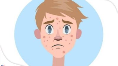 cara menghilangkan jerawat dalam 5 menit