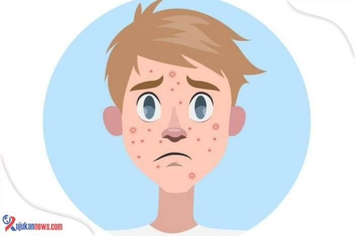 cara menghilangkan jerawat dalam 5 menit