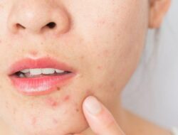 Ingin Perawatan yang Benar? 5 Cara Memilih Sunscreen Untuk Kulit Berjerawat!