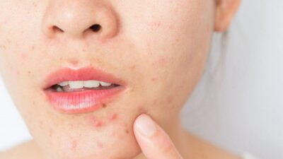 cara memilih sunscreen untuk kulit berjerawat